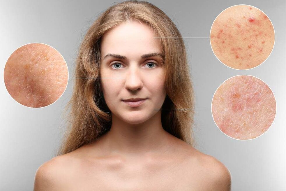 Hautausschläge im Gesicht aufgrund von Parasiten