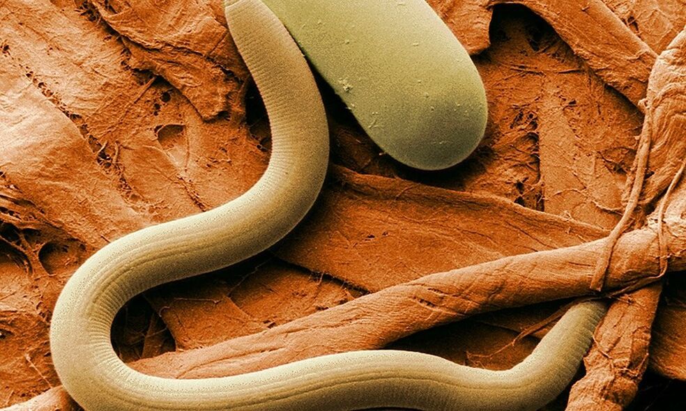 Wurmparasit aus dem menschlichen Körper